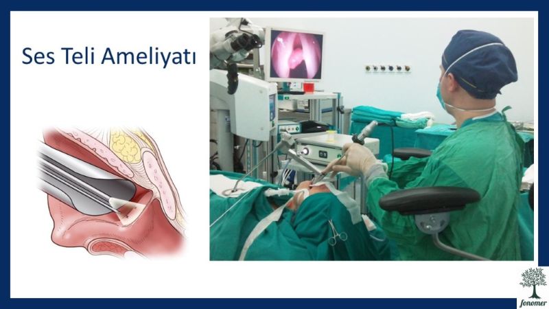 ses-teli-ameliyati-nedir