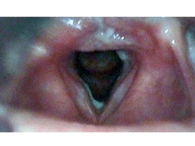 gastroozefageal-reflu