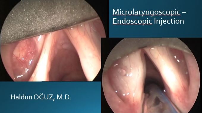 ses-teli-felci-tedavi-ankara1