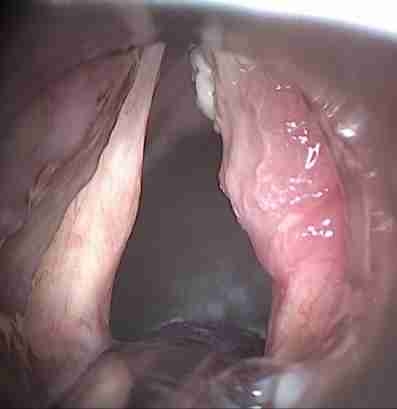 ses-teli-kanseri-ankara-kbb