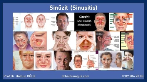 sinusitis-haldun-oguz